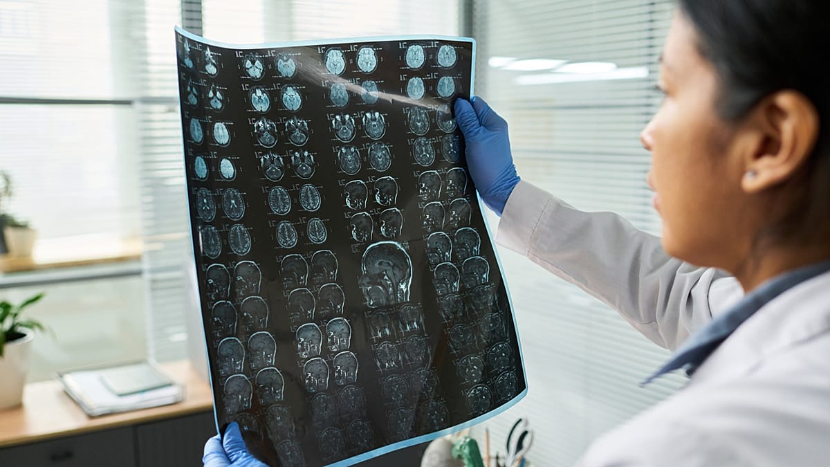 AI model inspired by ChatGPT predicts stroke risk from DNA