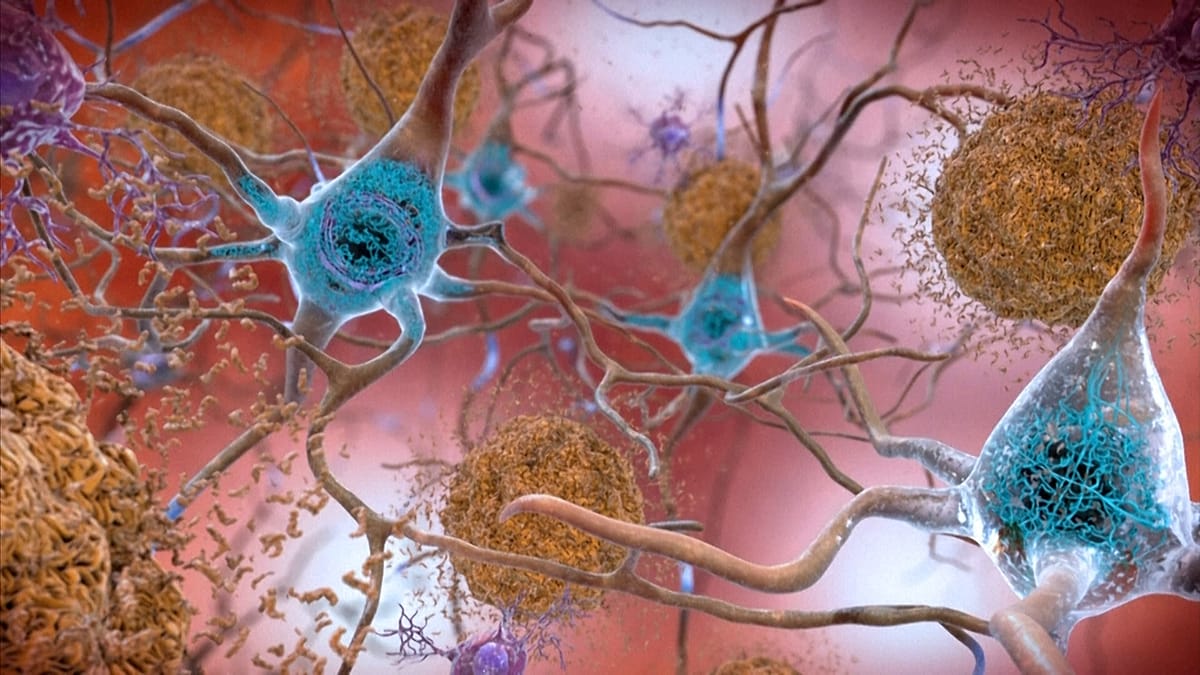 Blood Test Shows Promise for Early Alzheimer's Detection, but Experts Urge Caution