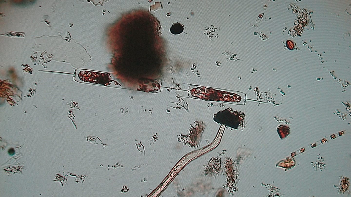 Flesh-Eating Bacteria Outbreaks Kill Over 100 in Europe in Two Years