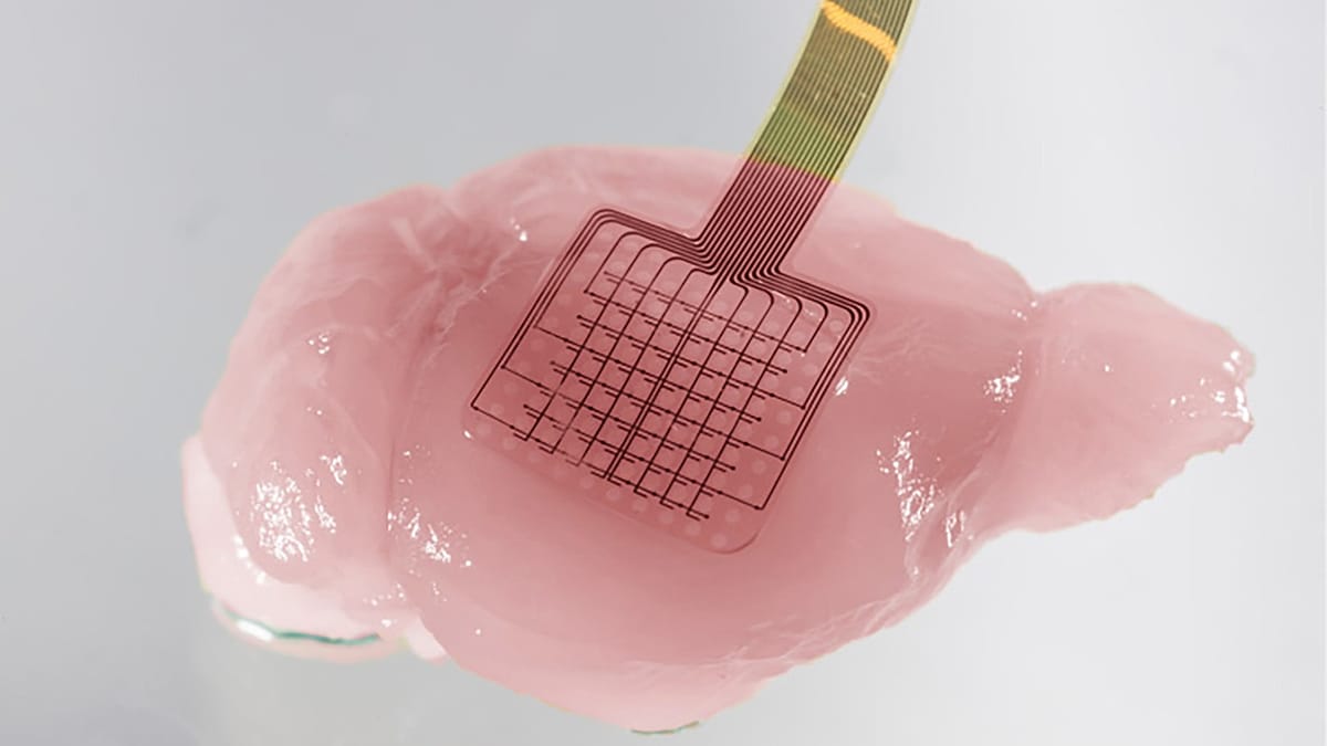 Graphene sensors map stroke damage in real time, Spanish-led team finds