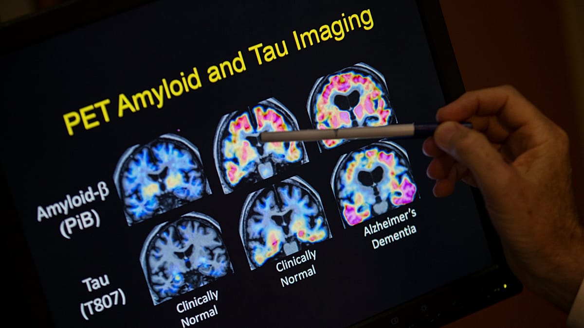 Greek scientists develop molecule that reverses memory loss in Alzheimer's models