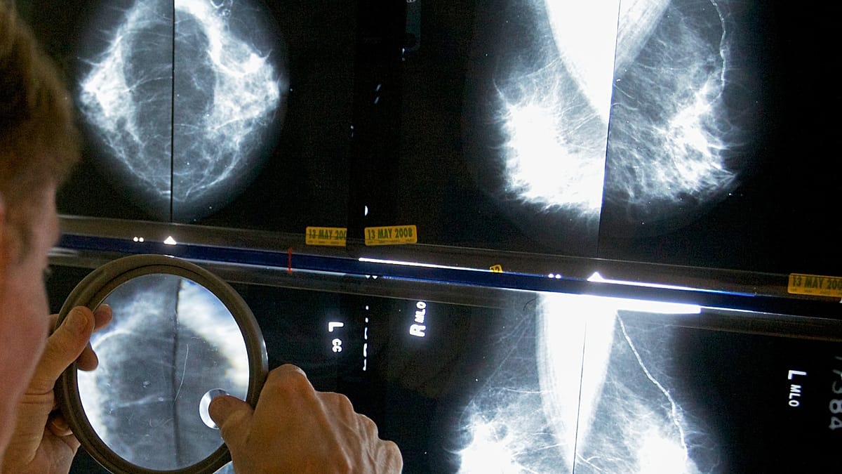 Spain Reports 111 Cases of Rare Lymphoma Linked to Breast Implants
